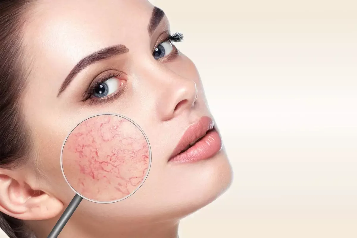 Couperose Coaguleren