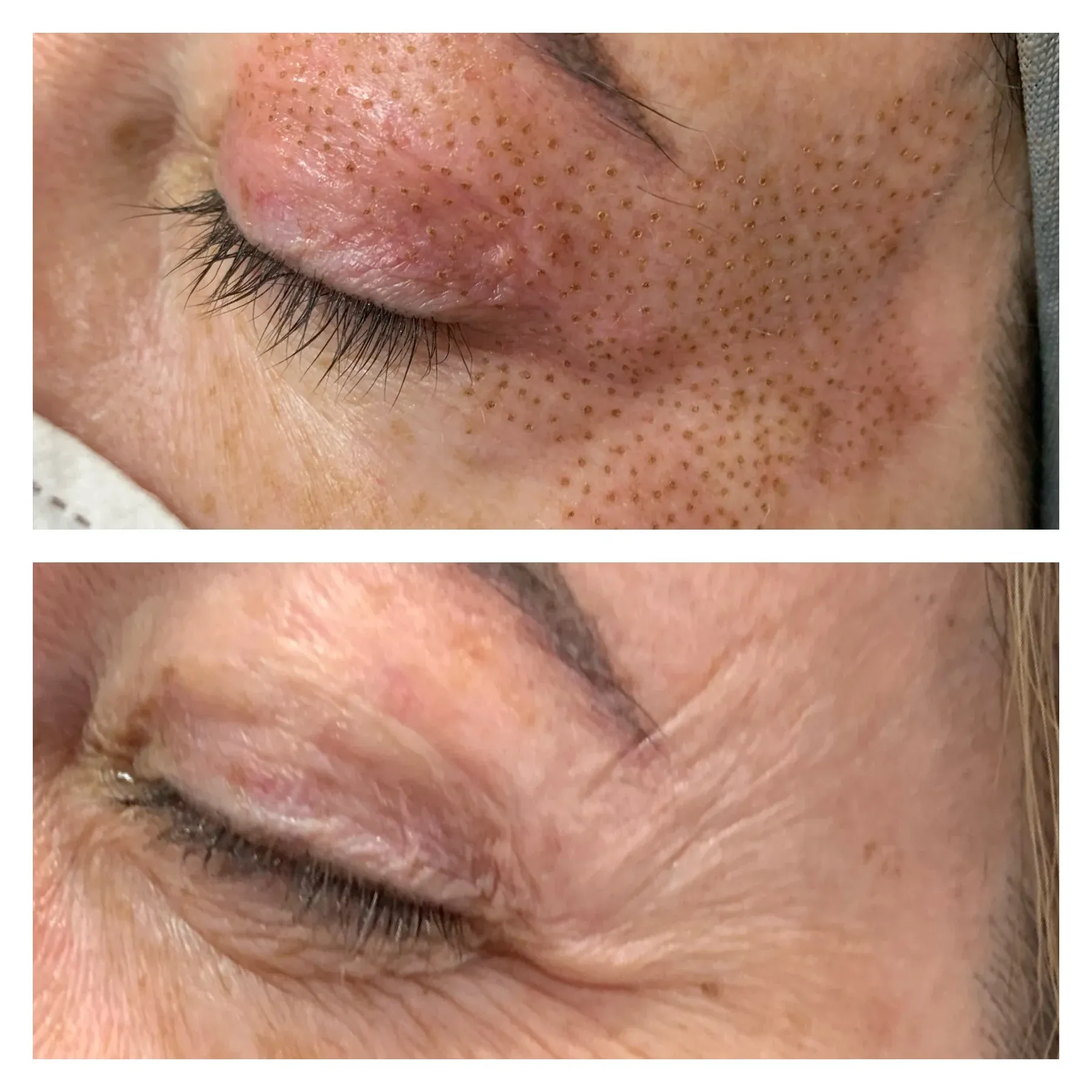 Phi Plasma Lift behandeling