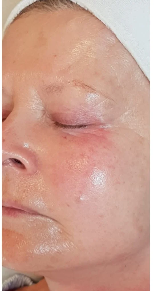 RF Facelift resultaat voor en na