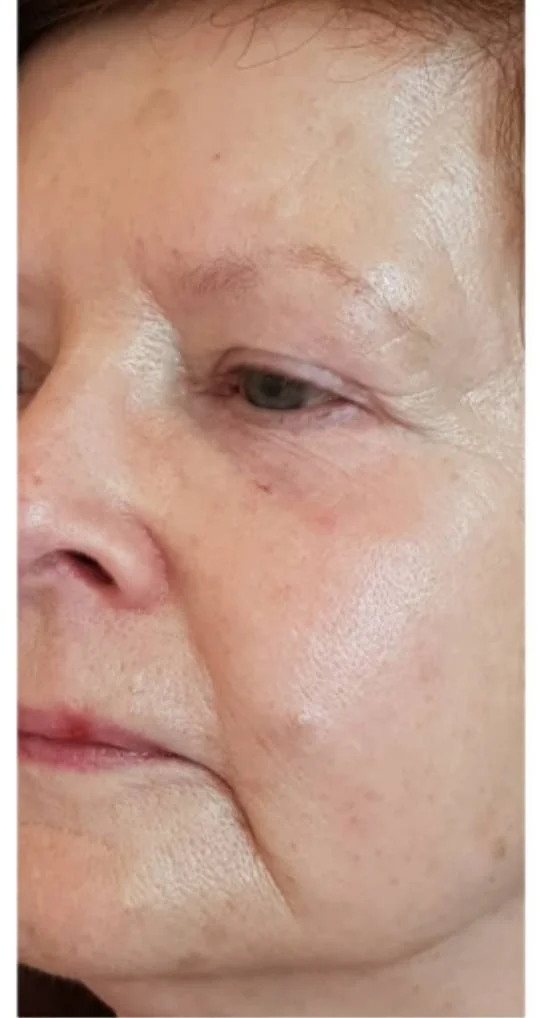 RF Facelift resultaat voor en na